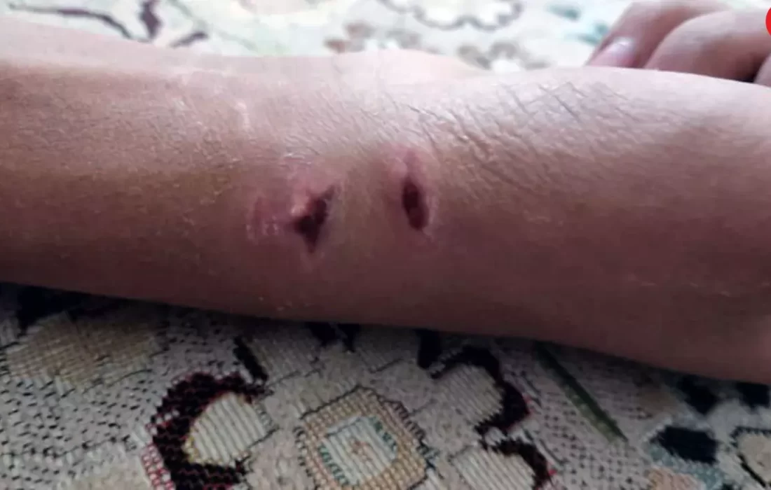 حمله شبانه سگ به پسر 15ساله در کوار