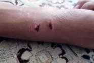 حمله شبانه سگ به پسر 15ساله در کوار